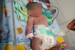 Ayah Bekerja sebagai Penambang Emas, Warga Curiga Bayi Lahir Bermata Satu di Sumatra karena Dampak Merkuri