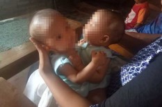 Alhamdulillah, Pengobatan Bayi Kembar Siam Dibantu Pemkab Gunungkidul, Termasuk Transportasi Pengobatan