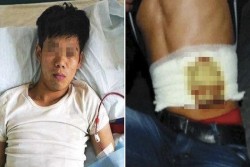 Kisah Tragis Pria yang Jual Ginjal Demi Beli Iphone, Ia Kini Lumpuh