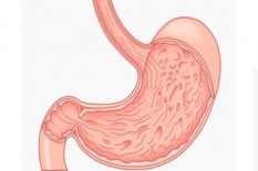 Atasi Obesitas dengan Memotong Lambung