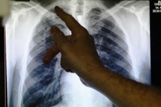 Ini yang Terjadi di Paru-Paru saat Terinfeksi virus Corona Menurut Pakar