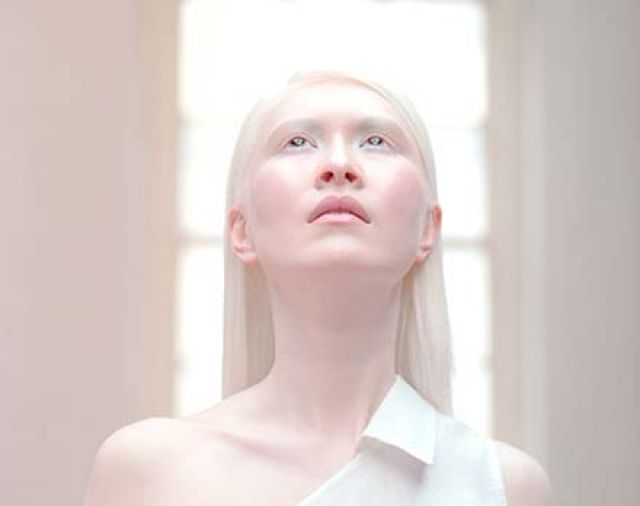 Kenali Penyebab Albino pada Manusia