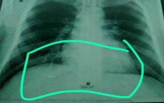 Pasien Corona Tak Sesak Napas Tapi Oksigen Dalam Tubuh Berkurang, Kenali Happy Hypoxia