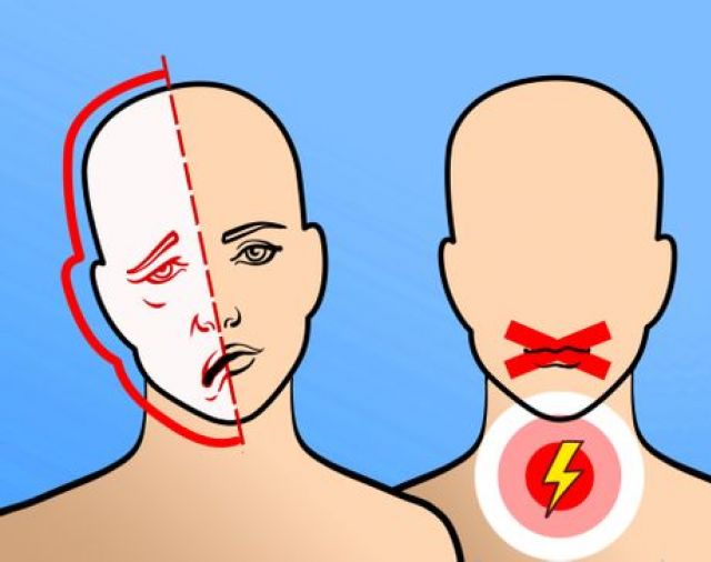 Wahai Anak Muda, Ini 7 Cara Mencegah Stroke Sejak Dini