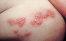 Alami Herpes atau Cacar Ular? Begni Cara Menanganinya...