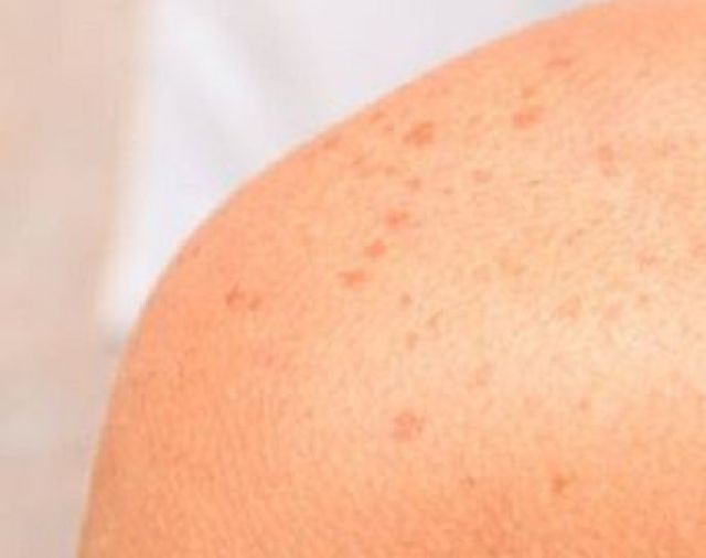 12 Tanda di Kulit Ini Jadi Gejala Awal Diabetes 