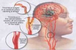 Ini 8 Penyebab Stroke di Usia Muda, Jangan Anggap Sepele