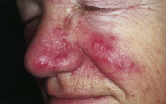 Mengenal Rosacea, Penyakit Kulit yang Diderita Maia Estianty