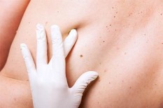 Waspada! Perubahan Tahi Lalat & Warna Urin Bisa Jadi Tanda Kanker Kulit Melanoma