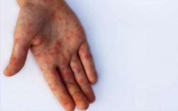 Waspada! Flu Singapura Rawan Menyerang Anak, Kenali Gejala dan Bahayanya