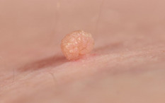 Mengenal Skin Tag dan Bagaimana Cara Menghilangkannya
