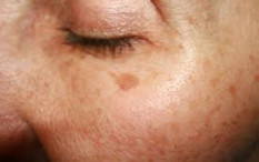 6 Tips Mudah Memudarkan Flek Hitam di Wajah