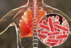 Gejala Penyakit Legionellosis: Mirip Covid dan Bisa Sebabkan Kematian