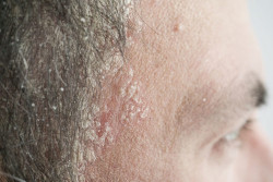 Kenali Bentuk Scalp Psoriasis yang Mirip Ketombe