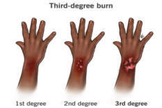 Begini Penanganan Tepat untuk Luka Bakar Ringan hingga Berat