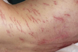 Hiperinfeksi Langka Membuat Kulit Pria Ini Penuh Ruam, Ternyata Dirayapi Cacing Gelang