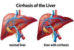 Ingat! Ini 8 Kebiasaan yang Dapat Merusak Organ Hati