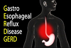 Punya Penyakit GERD? Jangan Melakukan Ini agar Tidak Fatal