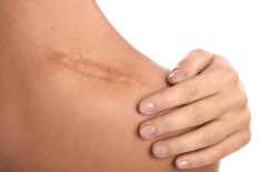 Anda Tak Nyaman karena Punya Keloid? Simak Penyebab dan Cara Menghilangkan Keloid