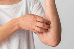 Mengenal Lupus, Penyakit Autoimun yang Lebih Berisiko Menyerang Perempuan