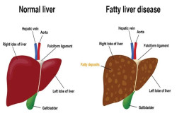 Tujuh Tanda pada Kulit Ini Menunjukkan Kesehatan Liver Anda Terganggu