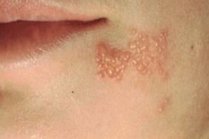 Virus Varicella-Zoster Bisa Aktif Kembali, Ancaman di Usia Dewasa