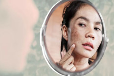 Bintik Hitam Muncul di Usia 30? Kenali Hiperpigmentasi dan Solusinya