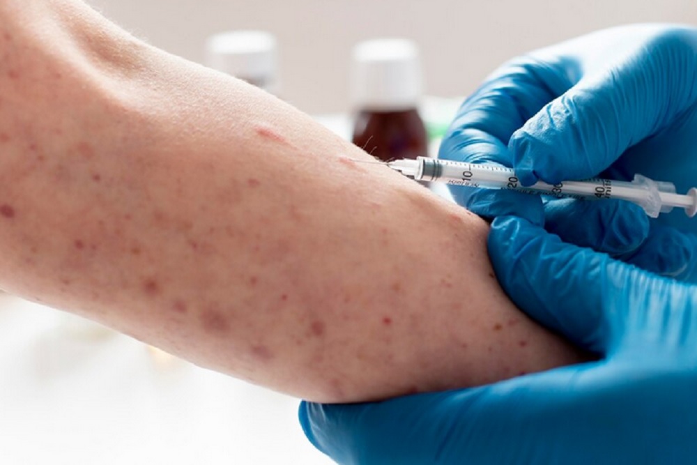 Monkey Malaria Mengintai, IDAI Ungkap Gejala Beratnya