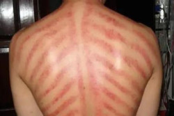 Nyeri Dada Jangan Dikerok, Ini Penjelasan Dokter