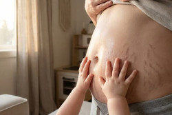 5 Penyebab Stretch Mark Saat Hamil, Bukan Cuma Kulit Meregang